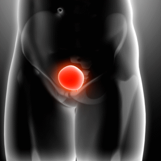 Curso de Cáncer de Vejiga