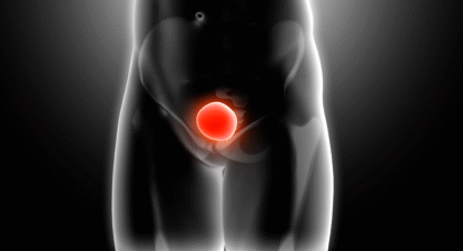Curso de Cáncer de Vejiga